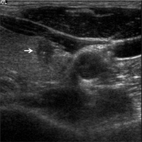 Ultrasonography performed on 51-year-old male with papi | Open-i