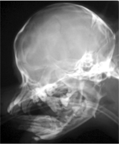 Lateral radiography reveals a mildly enlarged skull, an | Open-i