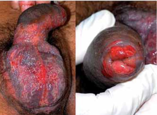 Lesions On The Penis 33