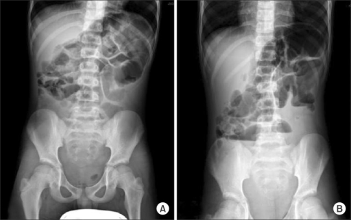 A Plain X Ray Of The Abdomen A Supine View B Erect Open I