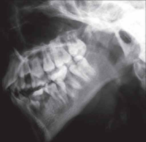 Lateral radiograph of the mandible shows small mandible | Open-i