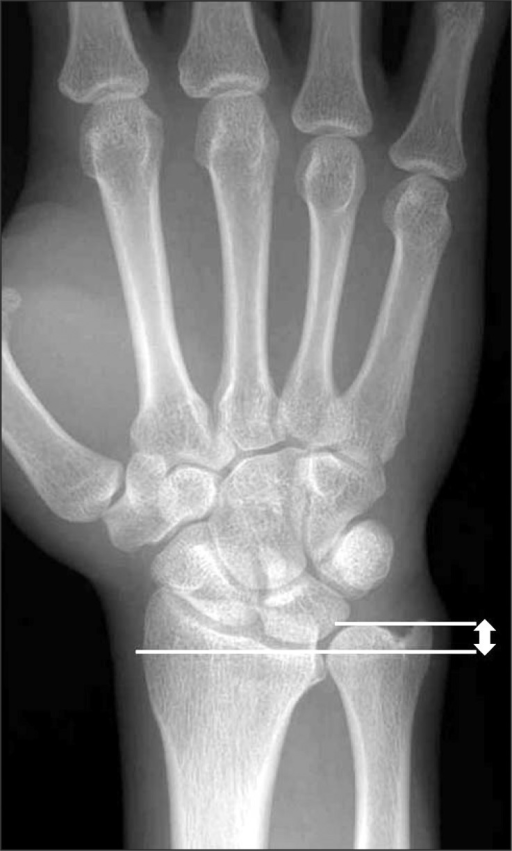 The ulnar variance was measured by drawing a line throu | Open-i