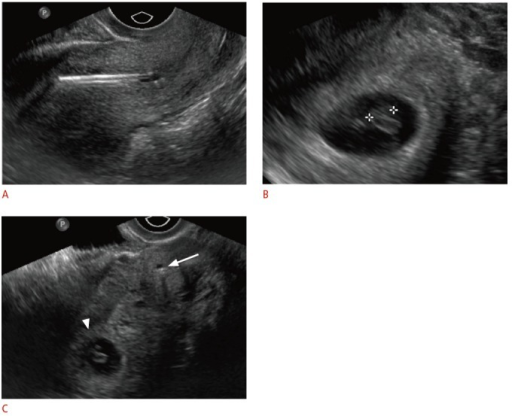 Displaced Intrauterine Device Iud In A 23 Year Old Fe Open I