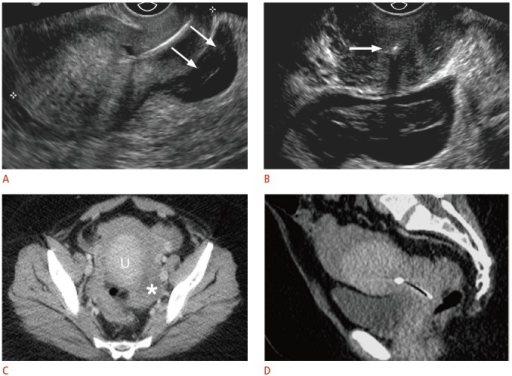 Displaced Intrauterine Device (IUD) With Ruptured Ectop | Open-i