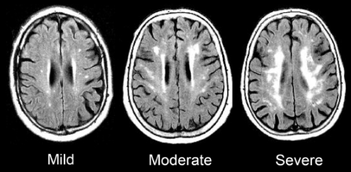 Fig 1 Age Related Changes In White Matter Three Severi Open I