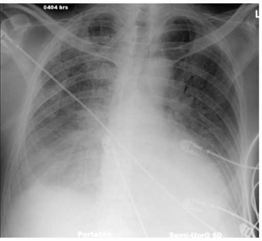 Portable AP chest radiograph of a 67 year old patient w | Open-i