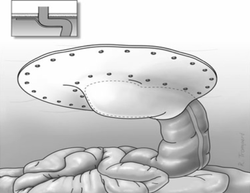 cpt-code-for-laparoscopic-hiatal-hernia-repair-appstadesigns