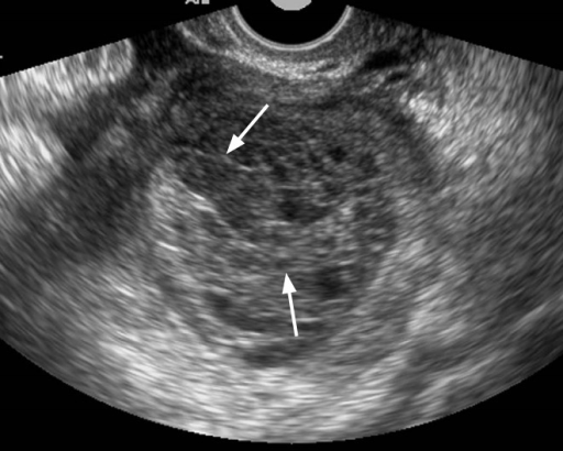 Hemorrhagic corpus luteal cyst in a 23-year-old woman.T | Open-i