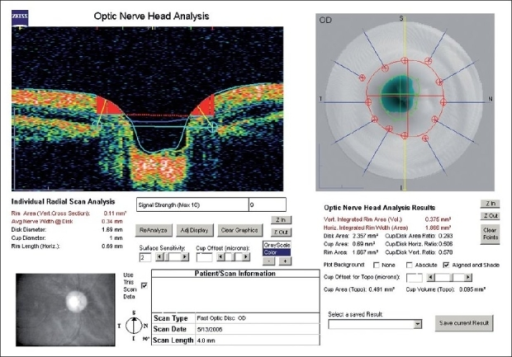 Optic Nerve Head Analysis With Oct Open I 9186