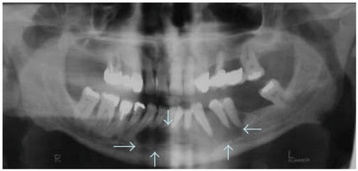 Case 1 Panoramic Radiograph Showing Lytic Multilocular Open I 4774