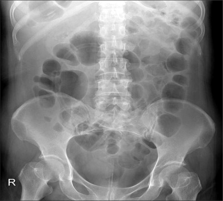 obstruction pseudo rectal tube intestinal ileus sigmoid paralytic extended colon openi myopathy visceral inserted length figure open nlm nih gov