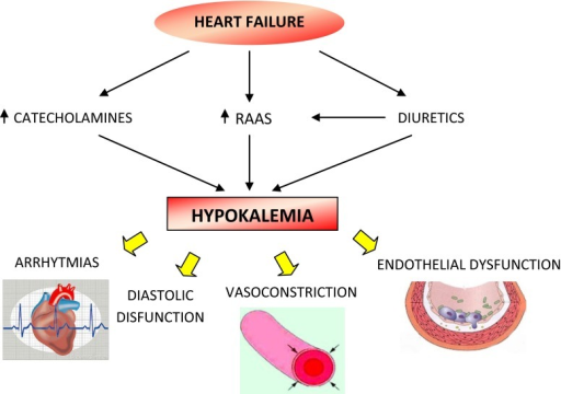 Hypokalemia in heart failure. RAAS renin–angiotensin | Open-i