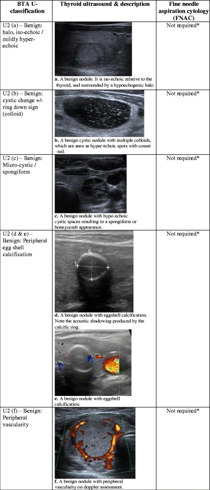 benign thyroid nodules