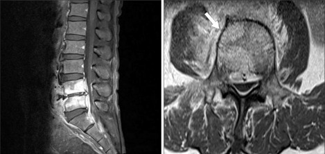 when to give mr contrast after lumbar surgery