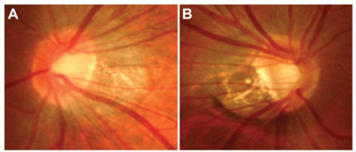 Optic Disc Photographs Fulfilling Our Criteria Of The T