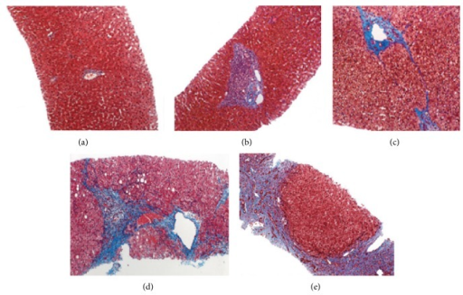 histological-staging-of-liver-fibrosis-photomicrograph-open-i