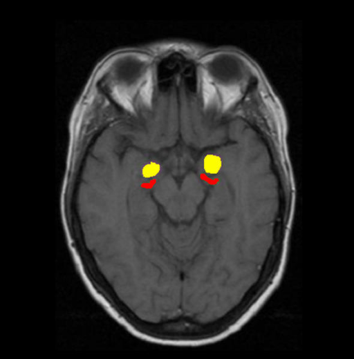 hippocampus anatomy radiology