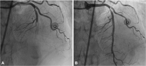 The First Event Of Stent Thrombosis. A: Coronary Angiog | Open-i