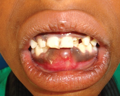 Clinical photograph showing the swelling in the mandibu