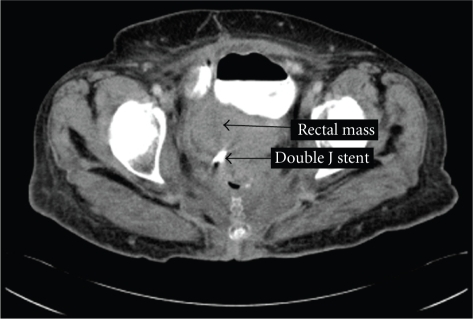 CT scan of pelvis showing rectal mass and double J sten | Open-i