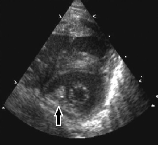 Video 6: Parachute mitral valve, transthoracic 2-D para | Open-i