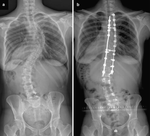 Female Patient With Adolescent Idiopathic Scoliosis Len | Open-i