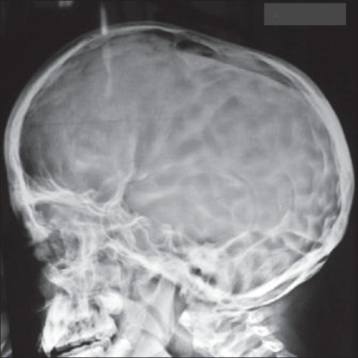 Skull X-ray showing osteopenic lesions and retained pri | Open-i