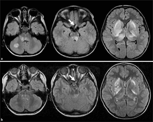 a Initial axial FLAIR images demonstrate marked high-si | Open-i