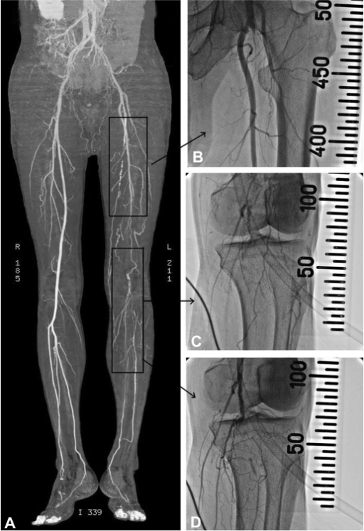 Computed tomography and angioplasty of the lower extrem | Open-i