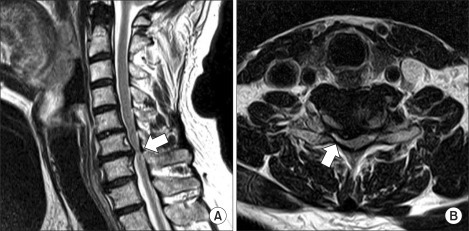 Magnetic Resonance Imaging Of Cervical Spine. Sagittal | Open-i