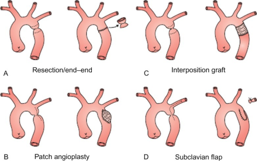 Major Surgical Aortic Coarctation Repair Techniques Open I