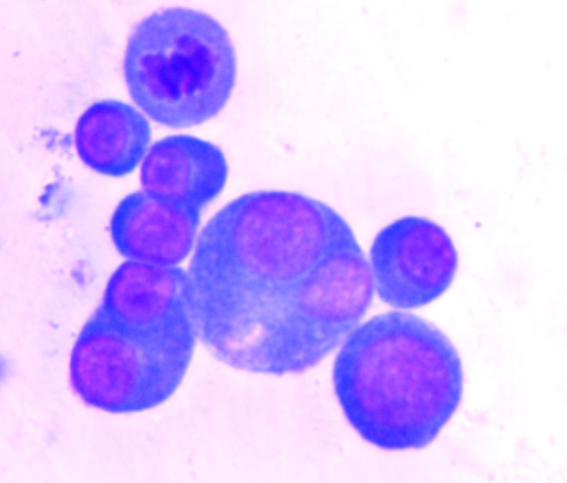 Tumor Cells In Pleural Fluid