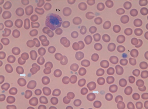 Photomicrograph Of The Blood Film (×100) Showing An Eo | Open-i