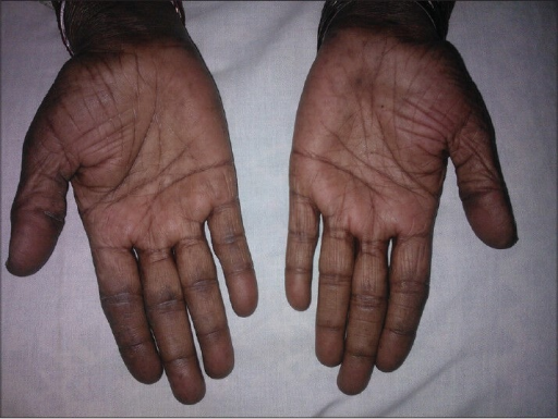 Hyperpigmentation of the palmar creases | Open-i