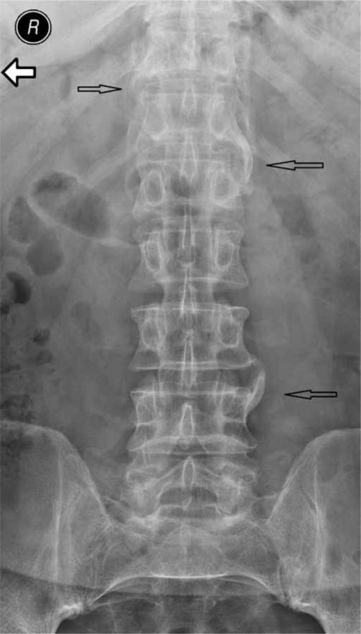 Lumbar spine AP X-ray of the 34 y.o. female patient with suspected PsA: osteoporosis, parasyndesmophytes in the thoracolumbar junction and on the left side of 4th lumbar vertebra (arrows), uneven articular surface of the sacroiliac joints as in erosions – changes indicative of bilateral sacroiliitis, grade 2