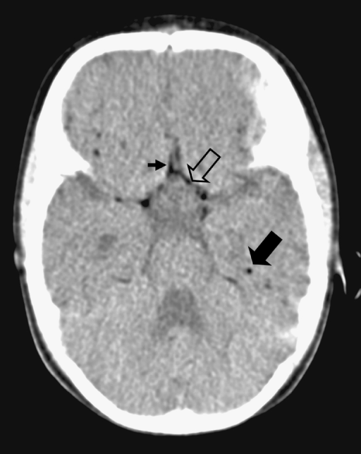 Ct At The Level Of The Circle Of Willis Showing Air Wit 