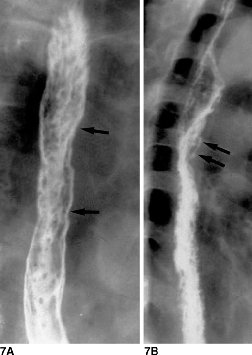 Candida Esophagitis In A 76 Year Old Man With Diabetes Open I