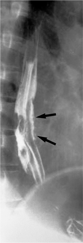 Behcet's disease in a 44-year-old man. Double-contrast | Open-i