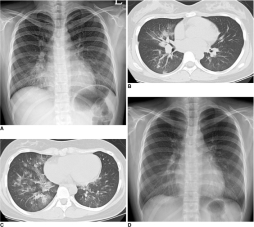 16-year-old girl diagnosed as novel influenza A (H1N1) | Open-i