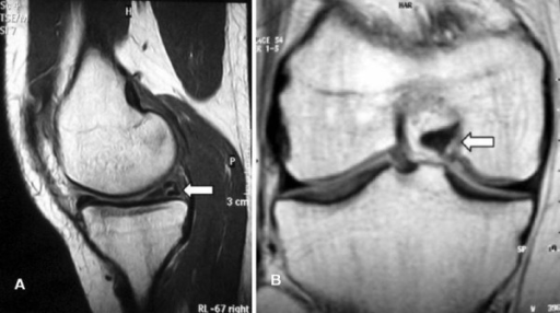 A Sagittal And B Coronal Magnetic Resonance Views R Open I