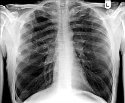 Patient 1. Bilateral apical bullae, more marked on the | Open-i