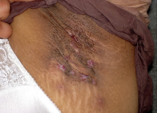 Hidradenitis suppurativa in the groin