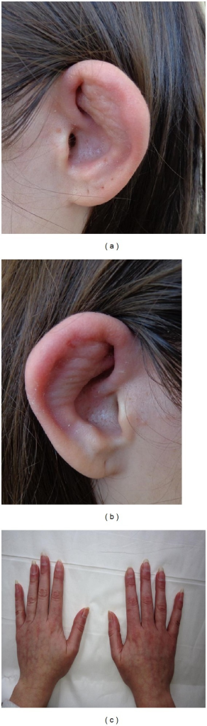 A B Cauliflower Ears Swelling And Erythema Of The C Open I