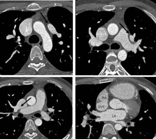 Partial anomalous pulmonary venous return of both lungs | Open-i