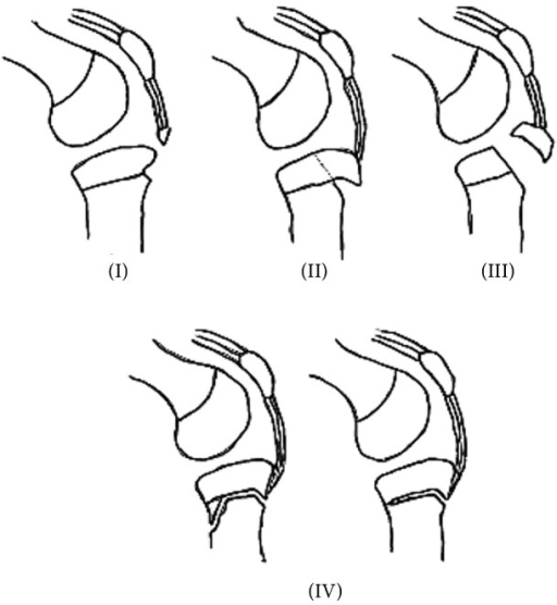 The modified Watson-Jones classification of tibial epip | Open-i