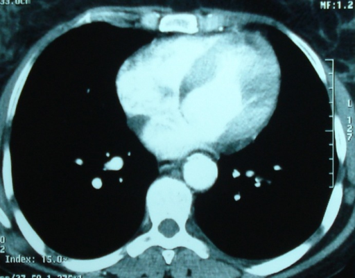 sténose aortique radiographie