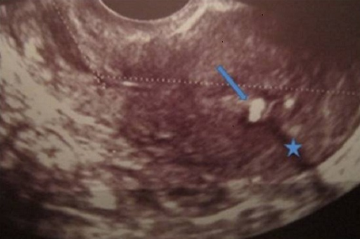image de l’uterus