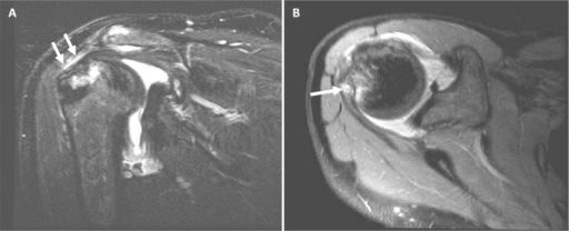 MRI of a humeral head Hill-Sachs lesion. A) Coronal-obl | Open-i