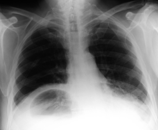 Chest x-ray on admission showing an unusual air fluid l | Open-i