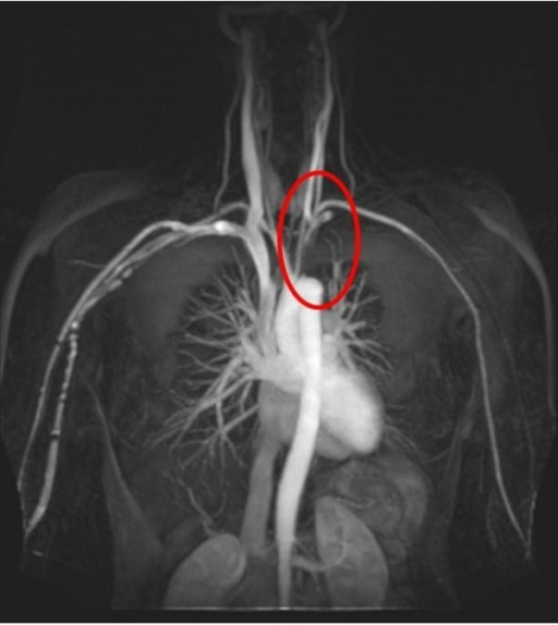 mri-showing-complete-occlusion-of-proximal-4-cm-of-left-open-i